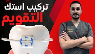 تركيب سلك واستك التقويم