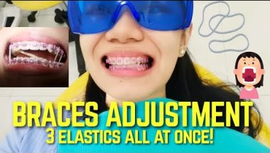 #BracesUpdate🦷: Adjustment Struggle + THREE ELASTICS 😭 (when your braces suddenly got serious 😩)