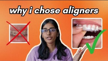 my honest aligners experience | why i chose aligners over braces ✨