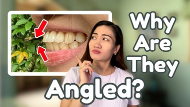 I Got Flared Teeth After Braces! And This is What I Did