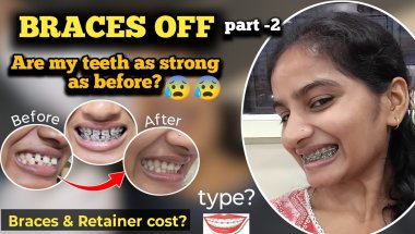I ate an Apple with my front teeth after getting my Braces off😰❗|my experience after Braces Off 😵