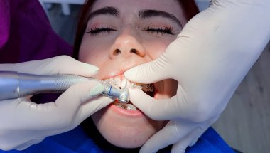 Full braces appointment- Removing a bracket