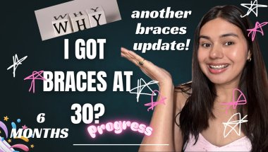 Why I Got Braces at 30! | 6-Month Update & Progress Revealed!