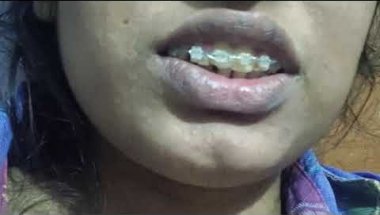 My braces experience/🥰!! My thoughts🤔💭 😒 #dentist #braceslife #bracestransformation  #youtubeindia
