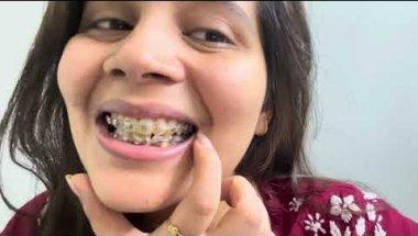 Braces pain /Braces cost /Braces all about #viral #dentist #trending #teethwhitening #braces #youtub