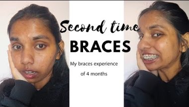 Second time braces |My braces experience
