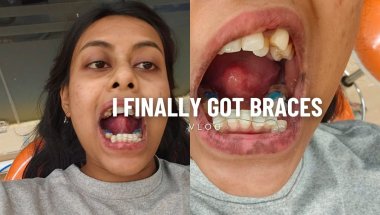 I finally got BRACES 💉🦷|| starting brace journey, abnormal crowding, orthodontic visits