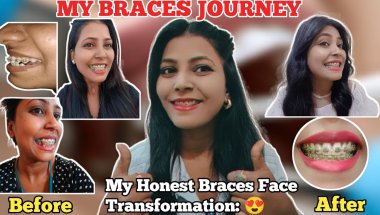 MY BRACES JOURNEY ll My Honest Braces Face Transformation: Retraction Reality!#braces #trending
