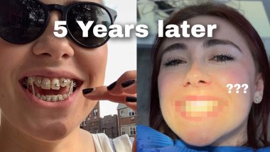 GETTING MY BRACES OFF
