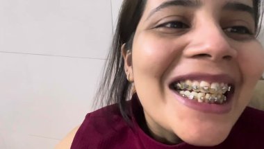 9 Months 4 days braces update#viral #dentist #trending #vlog #dentalartistry #teethdecay #teeth