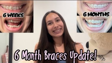 6 Month Braces Update | progress photos, pain levels, what I eat, etc. | Iconix Braces