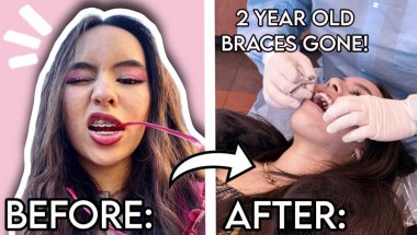 2 Years With Braces… THEY’RE OFF! 😱 ||Olivia Loren the makeup princess