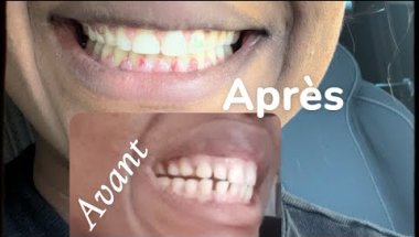 APPAREIL DENTAIRE INVISIBLE  😬￼ (Avant et après)