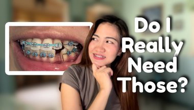 Should You Really Get Braces? Find Out Now!