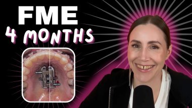 4 Months of FME: My Surprising Asymmetrical Expansion Experience!