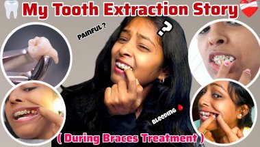 😰❤️‍🩹🦷 Scary Story of Tooth Extractions During Braces || 5 दांत उखड़वाए 🤢Watch this Before Treatment