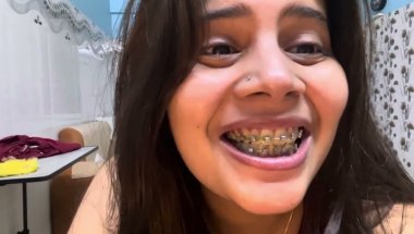 Braces kitne type ke hote hai#viral #teethwhiteningproducts #trending #teethwhitening #vlog #youtube