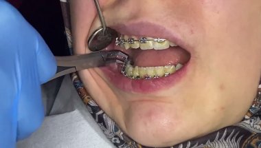Diş braketlerinin sökümü sandığınızdan çok daha kolay! Küçük bir dokunuş, hafif bir tık ve hepsi bu.