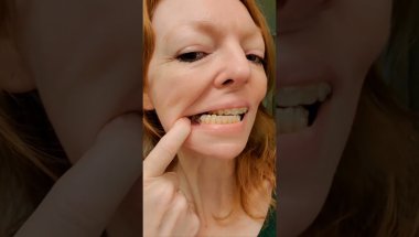 #Invisalign journey to straighten my smile..