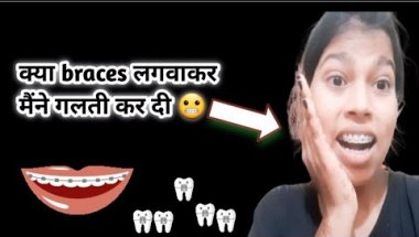 क्या मैंने braces लगवाकर गलती कर दी 😓🤔#dentist #dentalcare #viral #subscribe 🙏❤️.....