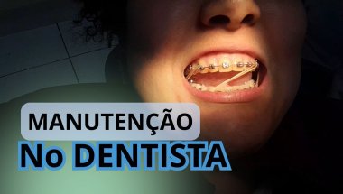 MANUTENÇÃO DO MEU APARELHO NO DENTE | RETA FINAL #dentista #aparelhoortodôntico #dentes #dental