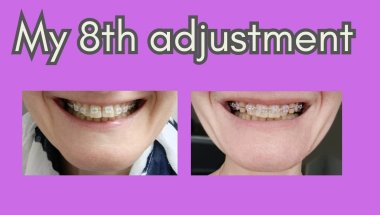 Adjustment no. 8😁 #braces #orthodontics #dentist #metalbraces #teeth #teethstraightening