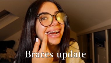 4 Months With Braces – My Experience & Tips 😬 vlog #4