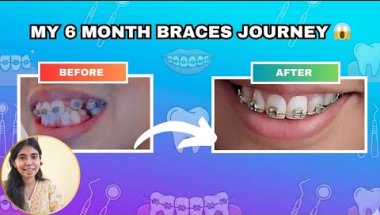 Meri braces journey 😰🦷 before and after || my 6 month braces update ( real experience)‼️#braceslife