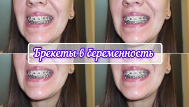 Брекеты и беременность #брекеты #элайнеры #проблемысзубами