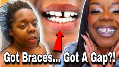 My Adult Braces Journey Took a TURN… SARPE Surgery, The Gap, & Everything They Don’t Tell You 😭🦷