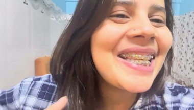 9 Months 19 day braces update #viral #dentist #trending #dentalcare #smiledesigndental #teeth #brace