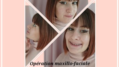 Opération des mâchoires : ostéotomie maxillo-mandibulaire + génioplastie