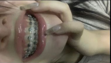 braceface!