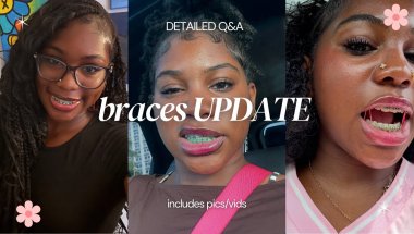 braces update: silently suffering (progress + Q&A)
