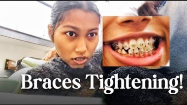 Braces Tightening: Does It Hurt? My Real Experience😬