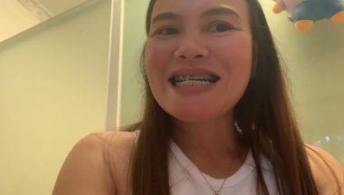 Change braces