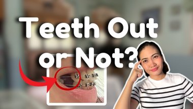 When and When not to have Premolars Extraction