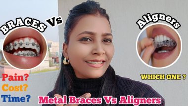 😨🦷Braces vs Aligners : Cost, Tooth Pain, Time, etc - The ULTIMATE Review 🔥 #braces #bracesjourney