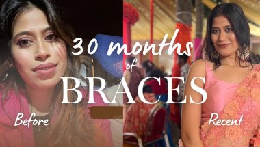 30 months of braces Journey | teeth 🦷 extraction | Cost ,time ,Age, experience