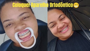 COLOQUEI APARELHO ORTODÔNTICO PELA 2 VEZ😁✨