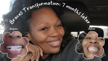 My Braces Transformation: 7 Months Later| Crowded Teeth |Bracket Repositioning#braces #orthodontics