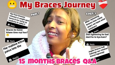 🦷😍15 Months complete With Braces || Q&A On Braces Cost pain Duration & Face looks All your Questions