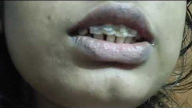 My 6 months experience with braces☺👏!! Ciremic #braces #dentist #smiledesigndental #transformation 👍