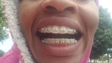 #aparelhoortodôntico #evolucion #white -Evolução/Teeth 🤍💀😁💀🦷⛷️🏂❄️🏔️🐻‍❄️🐻‍❄️🕊️