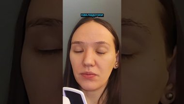 накладки для прикуса в ортодонтии #брекеты #ортодонтическое лечение #прикус