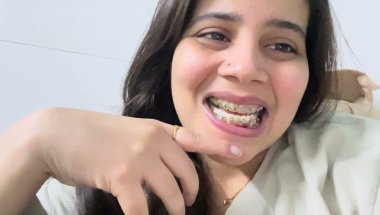 9Months 25 days braces update #viral #dentist #trending #smiledesigndental #vlog #dentalcare #teeth