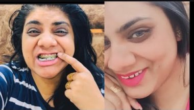 Braces ki vjhe sey bhut confidence aagya #viralvideo #braces