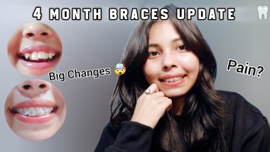 4 MONTH BRACES UPDATE! Progress, Pain & Big Changes🤯😍