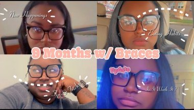 9 MONTHS W/ BRACES