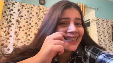 How braces are put on🤑#viral #trending #love #dentist #teeth #braces ##smiledesigndental #viral